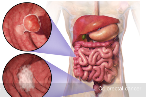 Understanding colorectal cancer symptoms and prevention strategies is crucial. Learn about lifestyle changes and the importance of early detection to reduce risk.