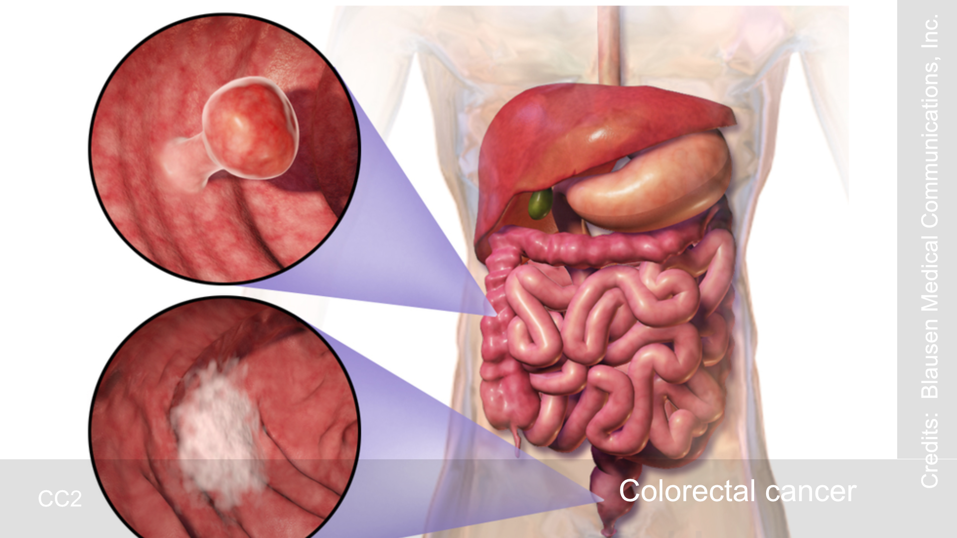 Understanding colorectal cancer symptoms and prevention strategies is crucial. Learn about lifestyle changes and the importance of early detection to reduce risk.