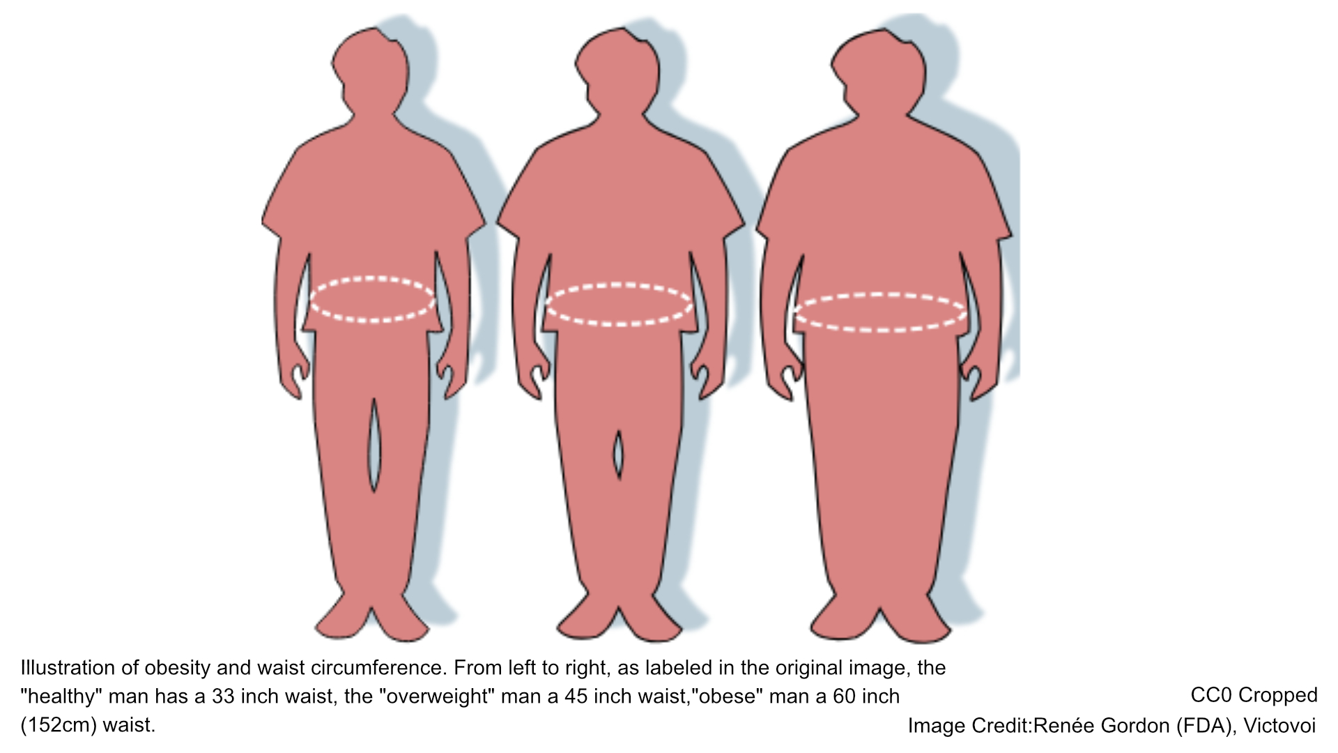 Illustration of obesity and waist circumference. From left to right, as labeled in the original image, the "healthy" man has a 33 inch waist, the "overweight" man a 45 inch waist,"obese" man a 60 inch (152cm) waist.