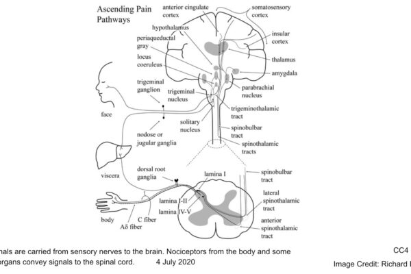 Pain signals are carried from sensory nerves to the brain