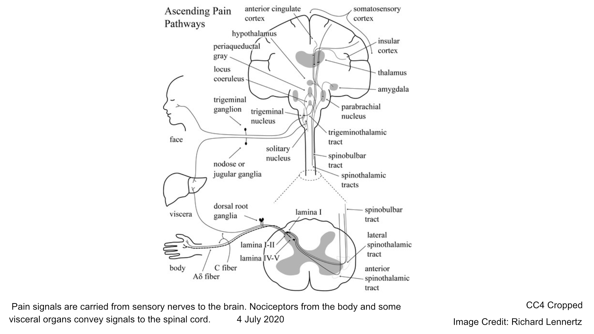 Pain signals are carried from sensory nerves to the brain